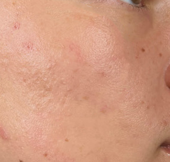 Before Vitalithe - Male