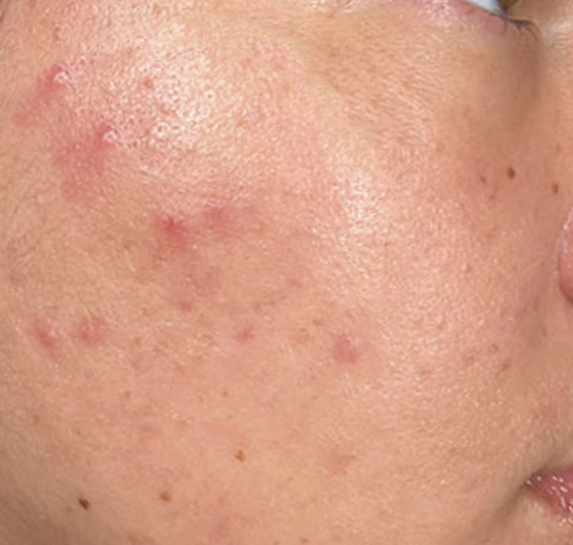 After Vitalithe - Male