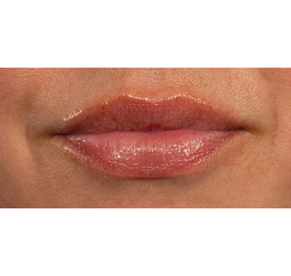 Before Vitalithe - Female