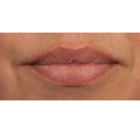 After Vitalithe - Female