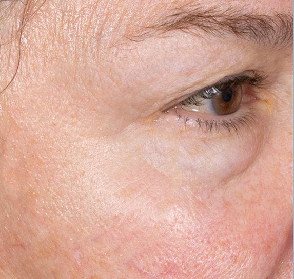 Before Vitalithe - Female