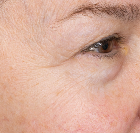 After Vitalithe - Female